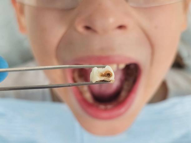 Best Urgent Care for Lost Fillings or Crowns in Sherwood, OR
